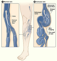 Natural Treatments For Varicose Veins