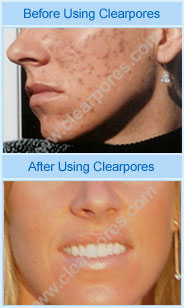 before and after clearpores